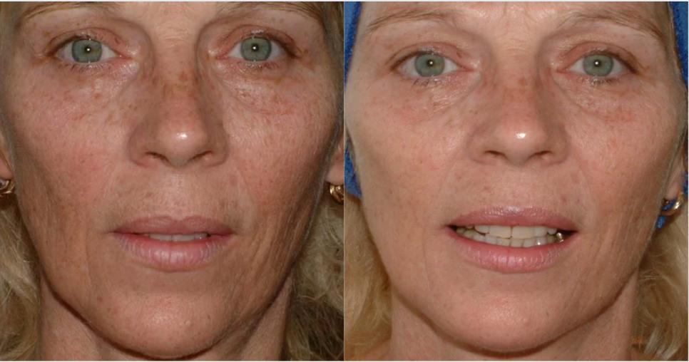 microneedling with mesotherapy before and after