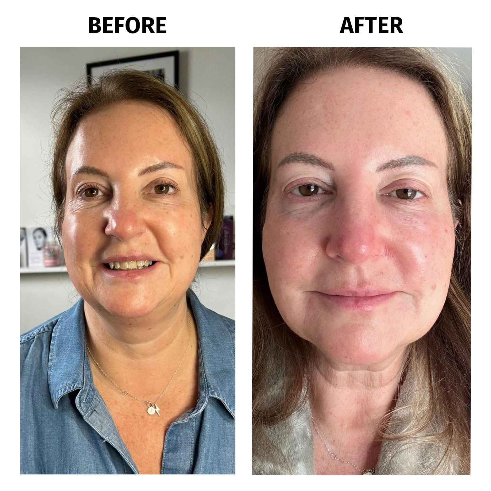 dermal fillers before and after